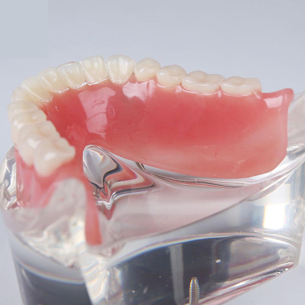 Dental Teeth Study Teach Model Overdenture Inferior 4 Implant Demo Model 