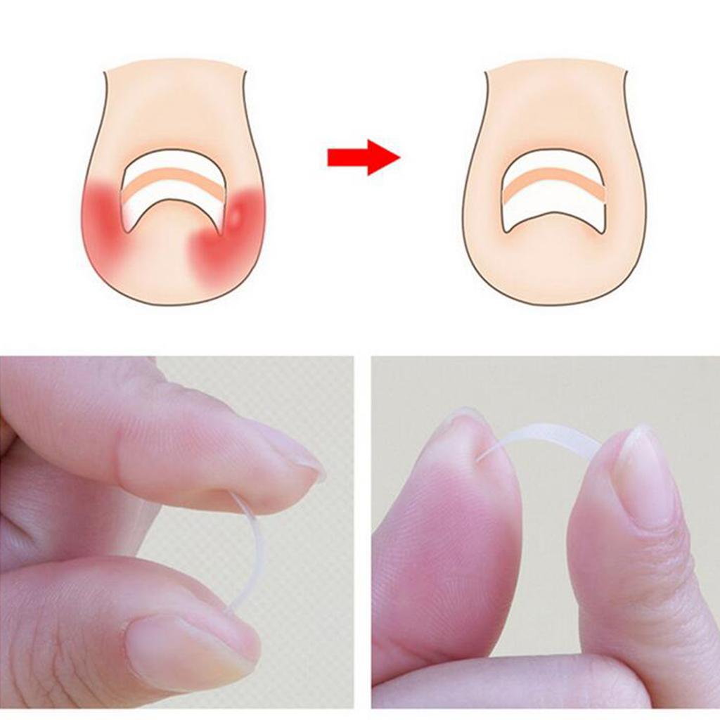 100Pcs Curved Ingrown Toenail Straightening Clips Set Nail Stickers Clear