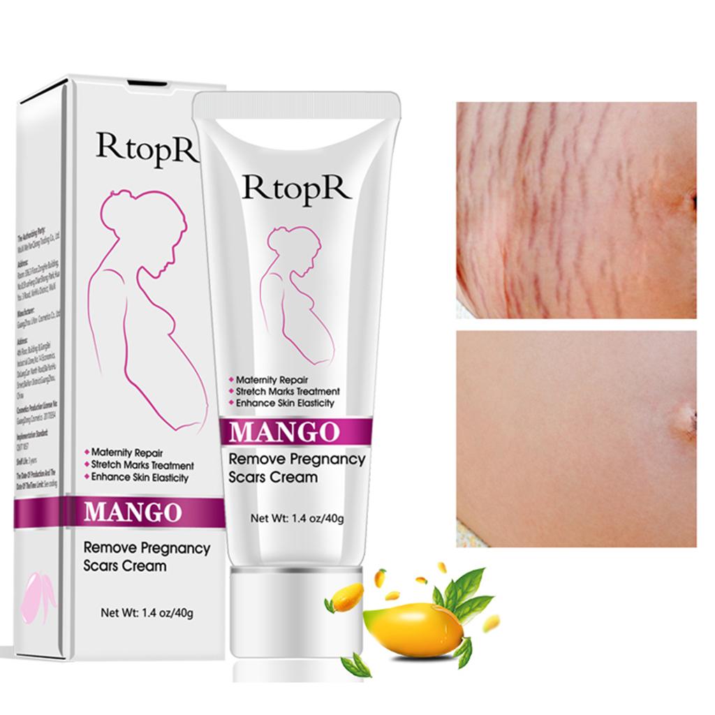 Mango Removing Pregnancy Scar Acne Body Cream Stretch Marks Treatment