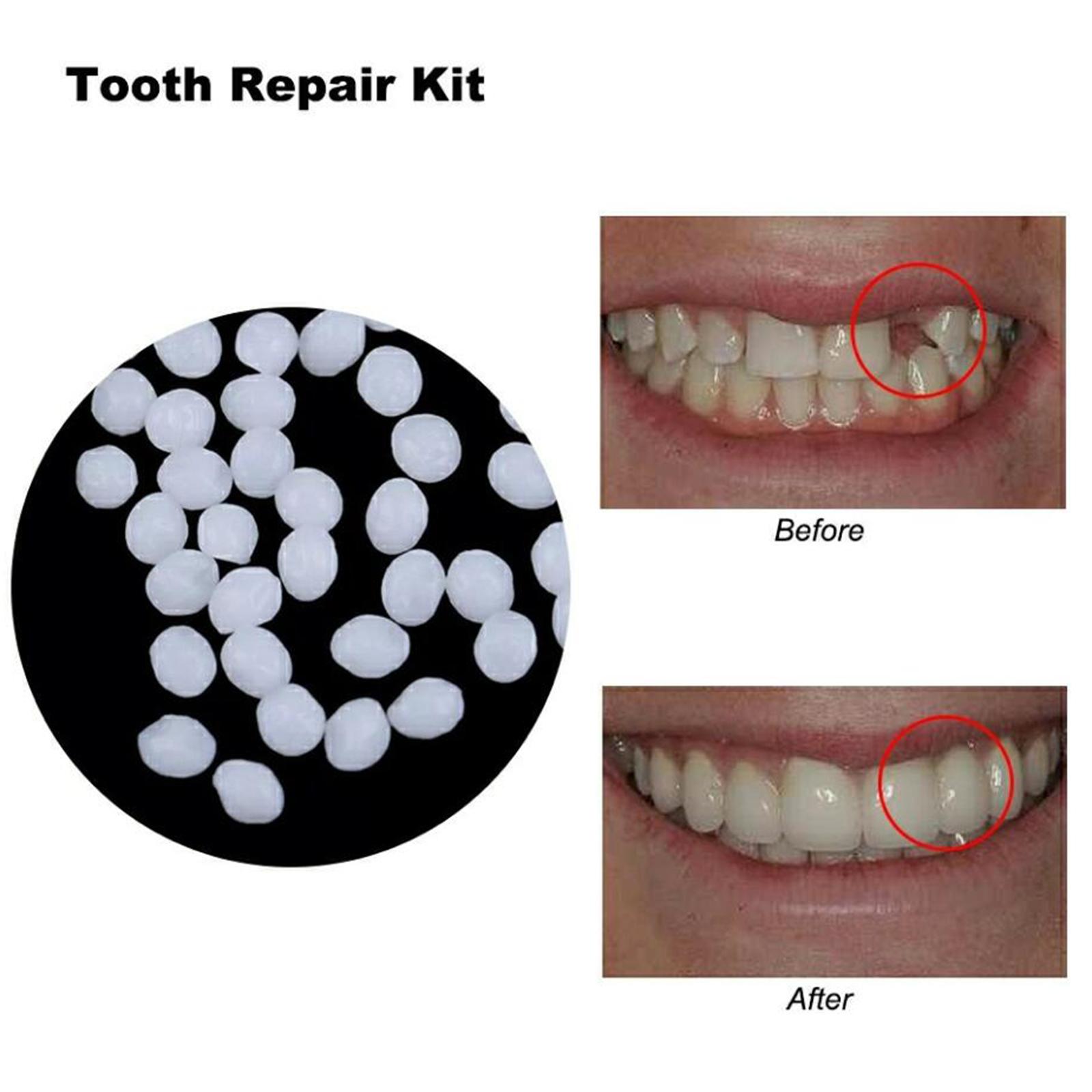 Dental Thermal Beads Teeth Veneers Moldable Denture Temporary Tooth Repair 25g
