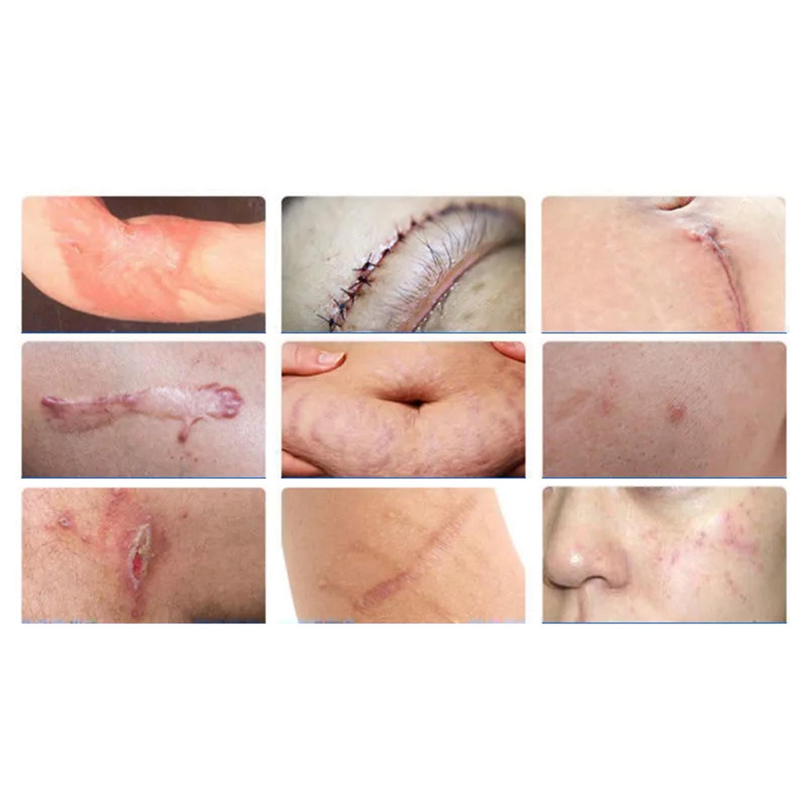 Silicone Scar Sheets Softening and Flattening for Keloid C Section 4x100cm