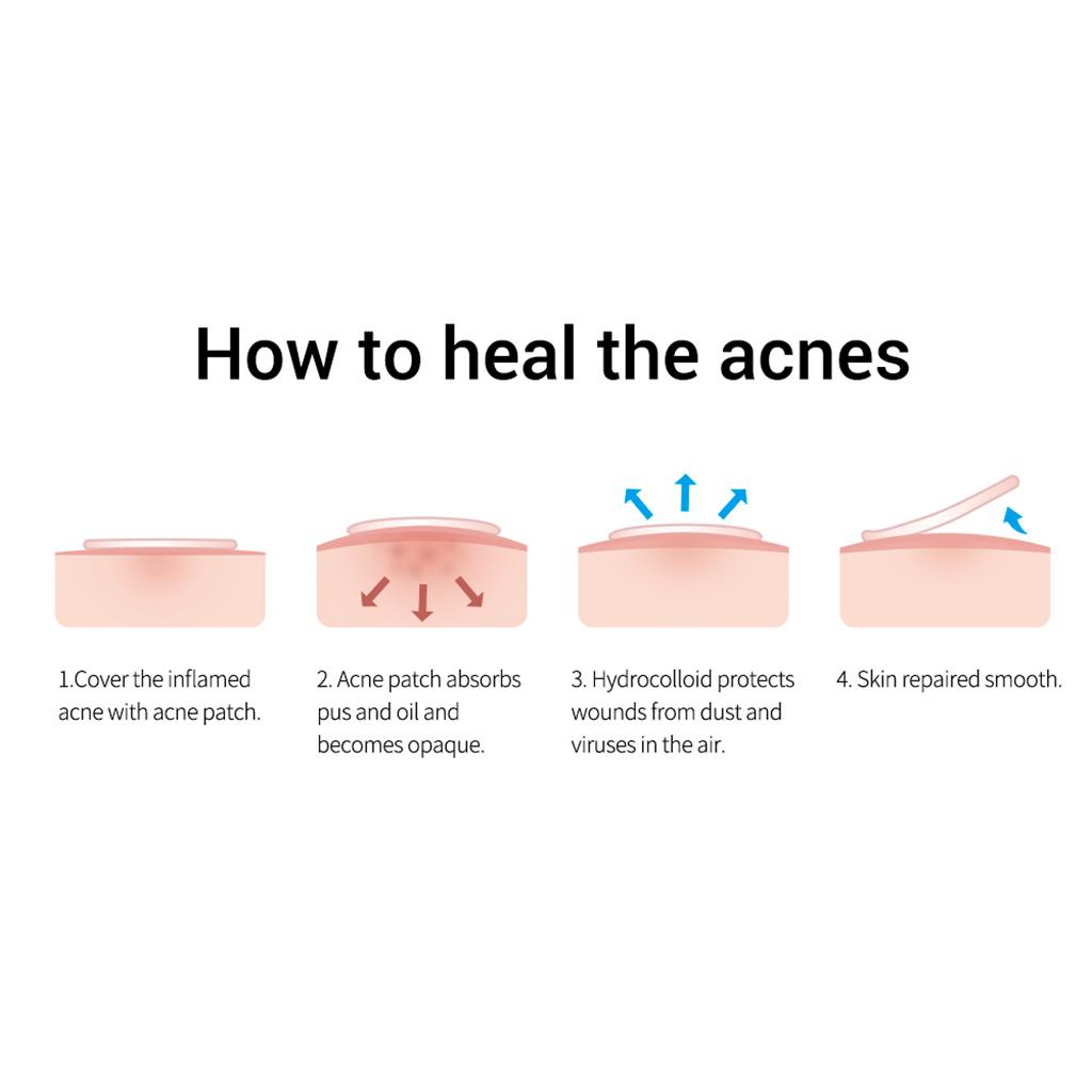 2x22pcs/sheet Breylee Tea Tree Acne Remover Patch Scar Treatment Stickers